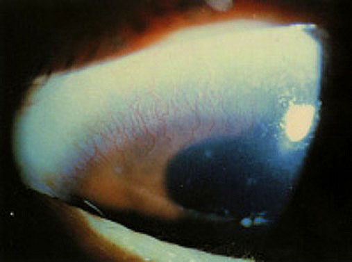 継続的な長期の酸素欠乏